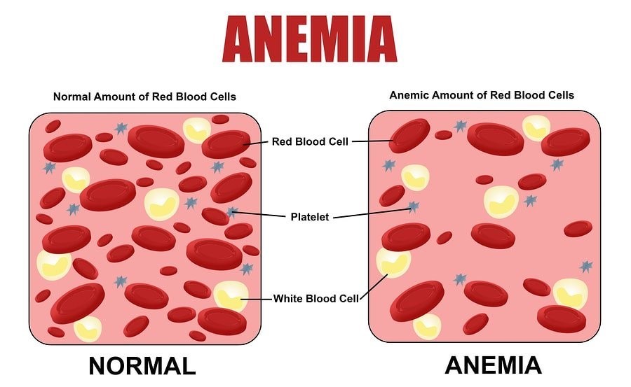anemia